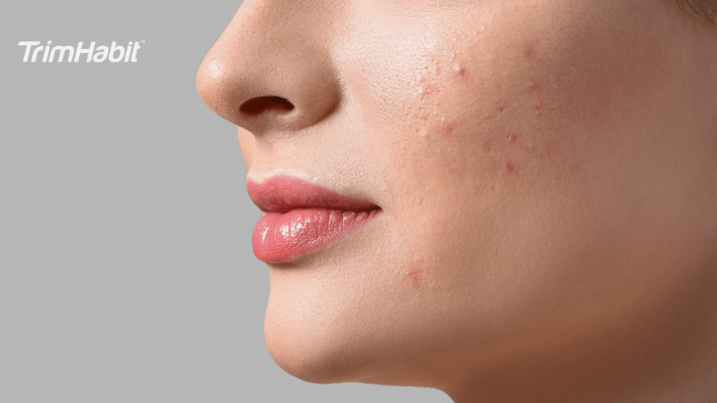 The Effect Of Intermittent Fasting On Skin Health And Acne